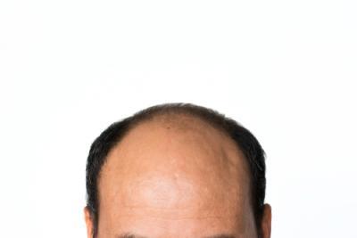 פתרונות שיער דליל לגבר ואיך לבחור נכון?
